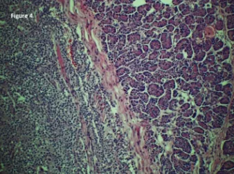 Figure 3: Open pancreatosplenectomy being performed through asubcostal incision in the left upper quadrant.