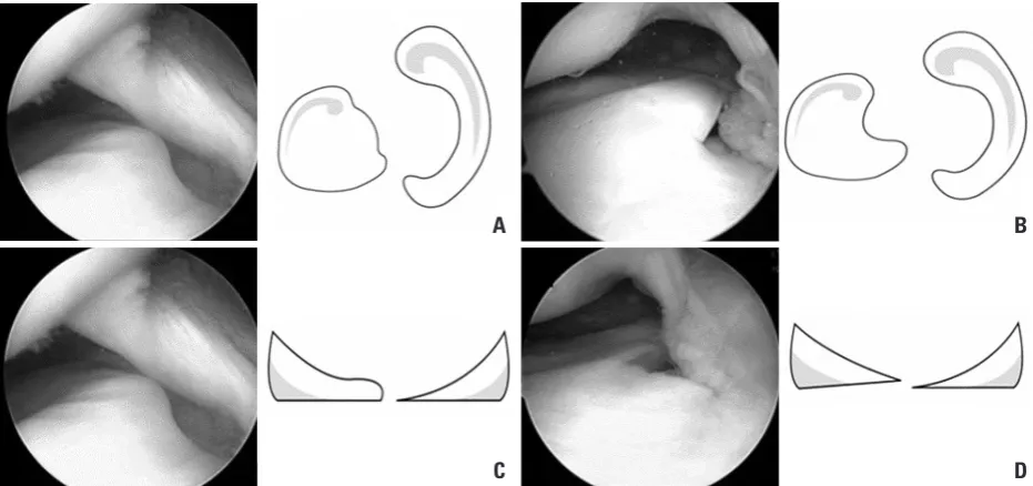 Fig. 1. Classification of the shape of complete discoid lateral meniscus based on the arthroscopic morphology of the medial edge