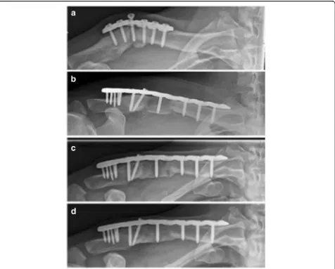 Fig. 4 Radiological outcome of a non-union after non-locking plate fixation with only two screws lateral to the fracture gap (patient No