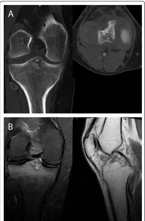 Figure 2 Arthroscopic view showing the aspect of the spinesarea after radiofrequency thermoablation and tibial surfacerupture.