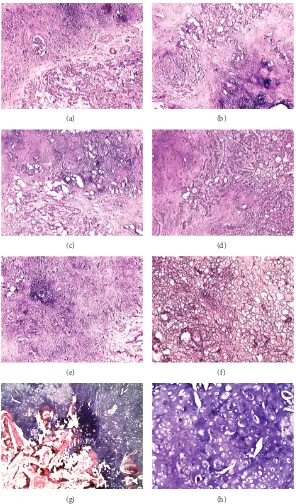 Figure 1: (a) and (b) Two components of PA, epithelial structure with glandular pattern and mesenchymal structure containing chondroidtissue and calcification