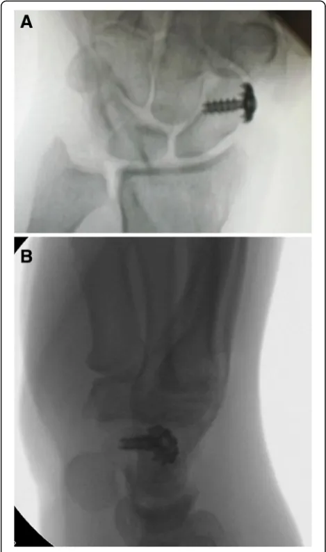 Fig. 3 A cannulated screw and spike-edged titan washer is appliedfor fixation of the ECRL tendon