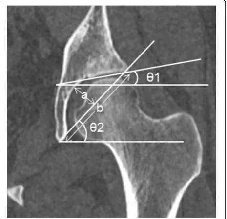 Fig. 1 Measurement of the parameters used to define acetabularacetabular depth ratio (ADR)