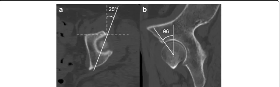 Fig. 4 Measurement of the vertical-center-anterior margin (VCA) angle on the sagittal plane
