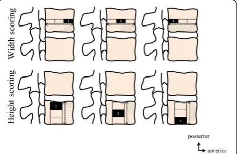 Fig. 1 Modic 1 changes width and height semi-quantitative scoringsystem. Modic 1 signal changes extending to the vertebral bodywere graded in the cranio-caudal axis for height and in the antero-posterior axis for width, based on the review of all slices, by using asemi-quantitative score ranging from 1 (edema involving < 1/3 ofthe vertebral body) to 3 (edema involving > 2/3 of thevertebral body)