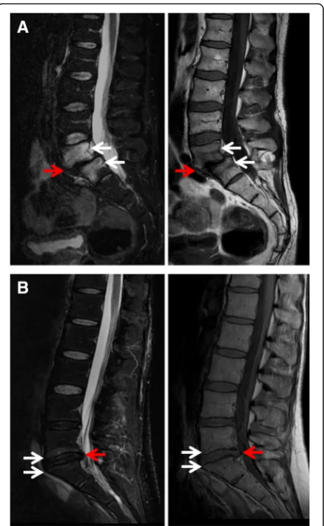Table 4 Intervertebral disc and vertebral endplate subchondralbone changes by intervertebral space narrowing at the level ofModic 1