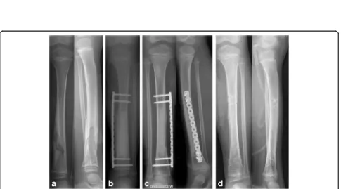 Fig. 1 Case 10, 50 Y, repeated swelling and skin ulcer of the right proximal tibia for more than 30 years