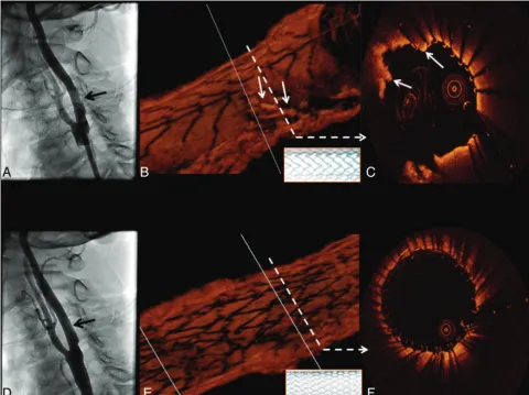 Fig 1. Tissue prolapse after stent implantation: an angiographic and 3D OCT evaluation