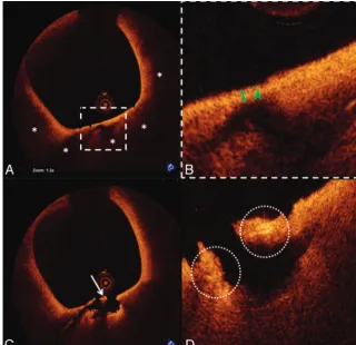Fig 2. TCFA rupture and inflammation visualized by OCT.corresponding to a lipid-rich plaque