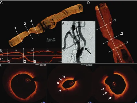 Fig 3. OCT 3D reconstruction of the right ICA.of interest along with proximal and distal reference segments