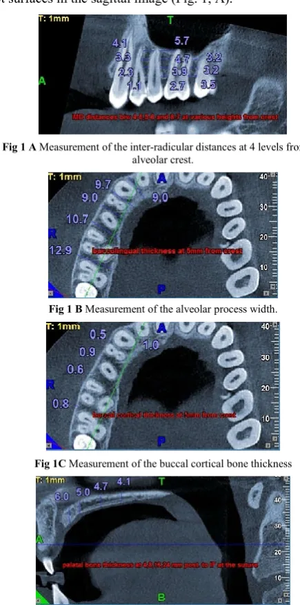 Fig 1 A Measurement of the inter-radicular distances at 4 levels from the 