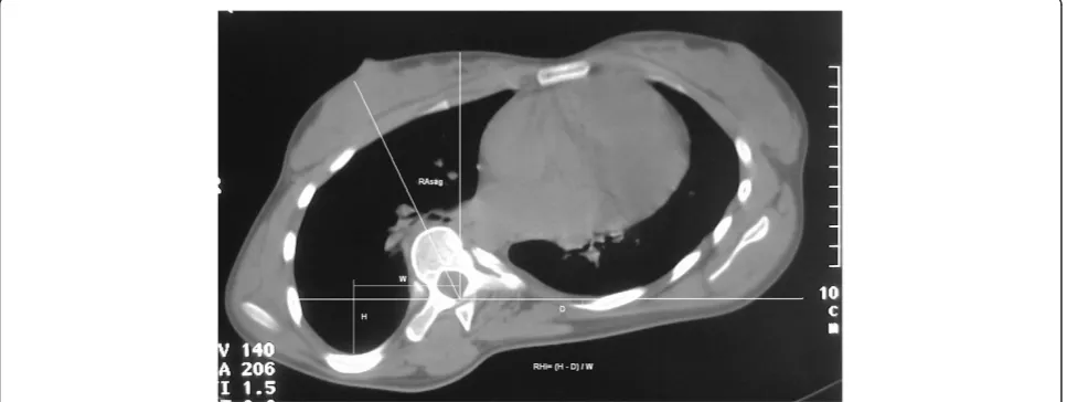 Figure 1 Spinal and rib cage CT scan at the apex of the curve. Measurement of the vertebral rotation angle about the longitudinal axisrelative to the sagittal plane RAsag and Rib Hump index RHi defined as the ratio (H-D) / W.