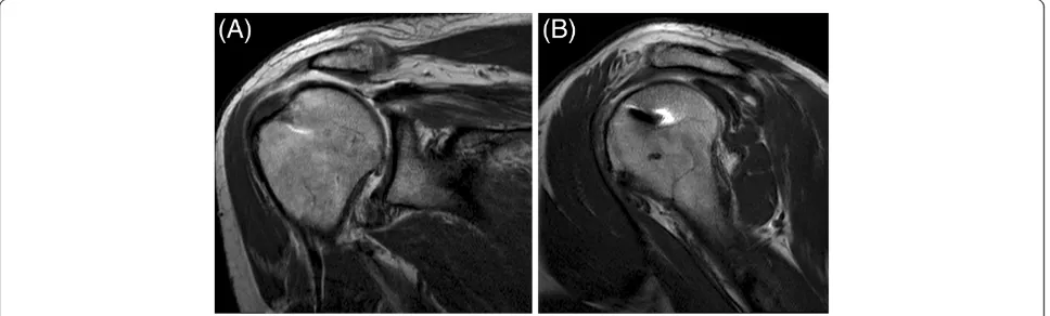 Figure 4 Coronal (A) and oblique sagittal (B) MRA views of the operated shoulder of a 48-year-old man (SR group), at 38-monthfollow-up, showed a type II tear of the rotator cuff, with a thin supraspinatus tendon (4.5 mm thick), leakage of the contrast medi