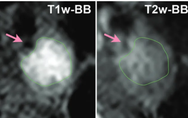 Fig 1. Coregistered multisequence MR imaging cross-sections of carotid plaque. Left: T1WI-BB