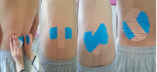 Figure 2 Space Correction Lumbar Star Taping