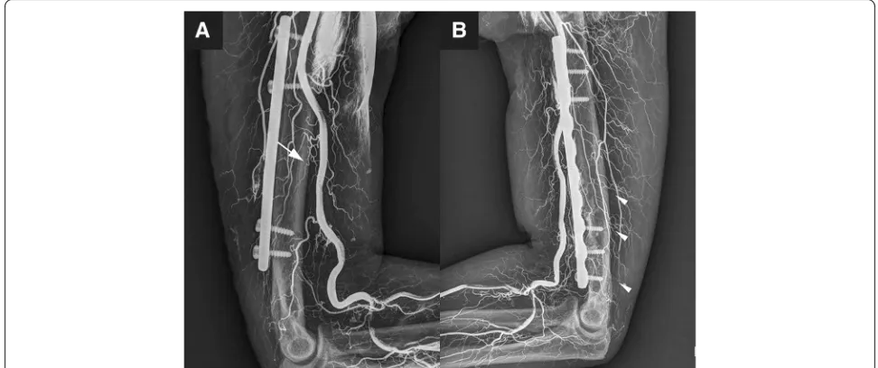 Fig. 1 Radiograph images of vascular perfusion. a shows the main nutrient artery (denoted by arrow) of the humeral shaft, b shows theaccessory nutrient arteries (denoted by arrow heads) of the humeral shaft