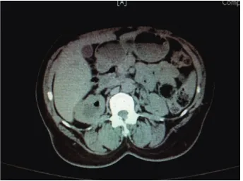 Figure 1: CT scan of the abdomen and pelvis showing marked righthydronephrosis with calculi, perinephric fat stranding, and gas inthe renal pelvis.