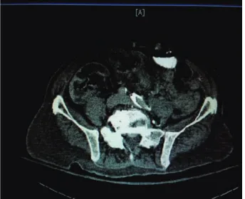 Figure 4: CT scan of the abdomen and pelvis showing left renalcalculi with foci or air in the renal parenchyma.