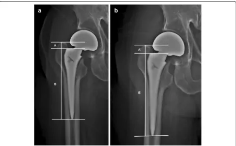 Fig. 1 alateral shoulder of the prosthesis and the superior tip of the greater trochanter was calculated using the equation: A X (Bcalculated as A Plain X-ray of the implanted femoral components taken immediately after surgery