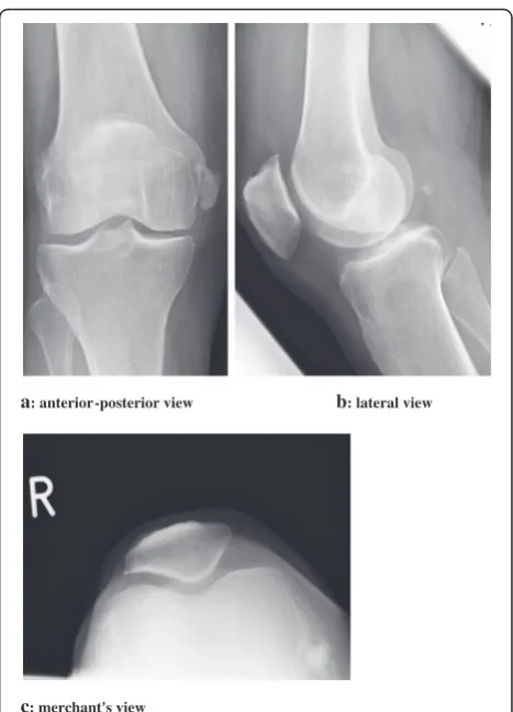 Fig. 1 Calcification body within the proximal and middle section ofthe MCL. It appears as homogeneous and round to ovoidcalcification in the soft tissue with well defined margins