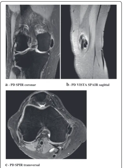 Fig. 2 Rounded area of low signal intensity on all imagingsequences in direct vicinity of the intact MCL, laying directly onthe ligament structure