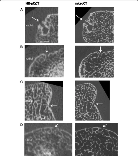 Fig. 1 Corresponding images of cortical breaks on HR-pQCT anddefinition for a break on HR-pQCT