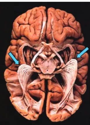 Fig 2. The OR exposed (virtual hospital). A brain viewed from below is prepared by usingthe Klingler fiber dissection technique