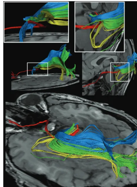 Fig 5. Reconstructions of the optic nerve and tract (red), the Meyer loop (yellow), thecentral bundle (green), and the dorsal bundle (blue) in different planes