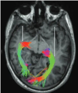 Fig 7. Reconstructed OR by using the probabilistic method of CSDadolescent with a small right cerebral hemisphere