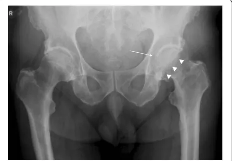 Fig. 1 Pelvic X-ray with signs of arthrosis consisting of a double fondosteophyte (DFO) (thin arrow on the left) and a posterior wall sign(PWS) (thick arrows on the right)