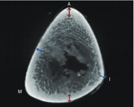 Fig. 3. Orientation of Schanz screws inserted by the conventional method and vertical method