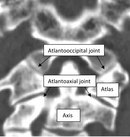 Figure 1 Coronal view of a CT scan showing Occipitoatlantoaxial complex  
