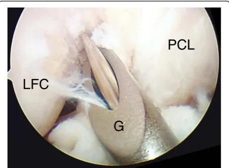 Figure 4 An offset guide position in arthroscopic view by useof lateral infrapatellar portal