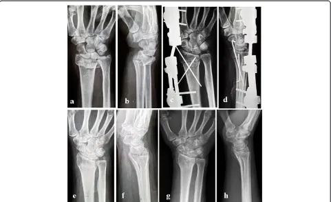 Figure 1 The 65-year-old male patient with unstable distal radius fracture.distal radius showed an unstable fracture accompanied with the ulnar styloid base fracture: dorsal angulation at 30°; shortening of radius 7 mm.(wires