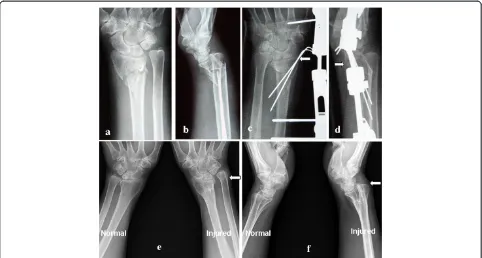 Figure 2 The 56-year-old female patient with unstable distal radius fracture. (a, b) The initial anterior-posterior and lateral radiographs of thedistal radius showed an unstable fracture without an ulnar styloid fracture: volar comminution of the metaphys