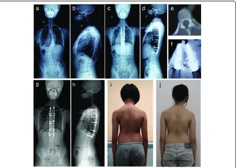 Figure 2 Case 1.months after surgery, radiographs show that the correction over the instrumented levels was maintained; A 13-year-old female patient with Lenke type 1BN IS was treated with bilateral apical vertebral derotation by VCM