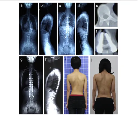 Figure 3 Case 2.correction over the instrumented levels was maintained; A 20-year-old female patient with Lenke type 1AN IS was treated with VCA technique