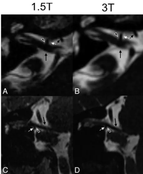 Fig 5. Bar graph showing the mean (between the basilar artery and brain stem, and CNR between the CSF and ICA for both the3D-CISS and 3D-TOF MRA