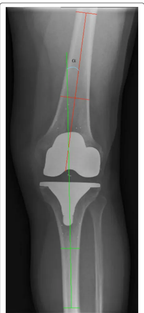 Fig. 1 Measurement of the anatomical alignment (α) of a knee afterprimary TKA with a Vanguard ROCC knee prosthesis as presented byPetersen et al