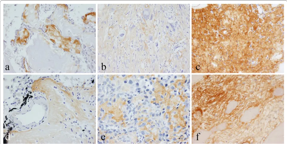 Fig. 1 Immunohistochemical staining for periostin in osteoid/newly formed bone of: a osteoblastoma; b high-grade osteoblastic osteosarcoma; c osteoid-rich area of high-grade osteosarcoma; d small cell osteosarcoma; e osteosarcoma metastasis in lung; f fibrous dysplasia