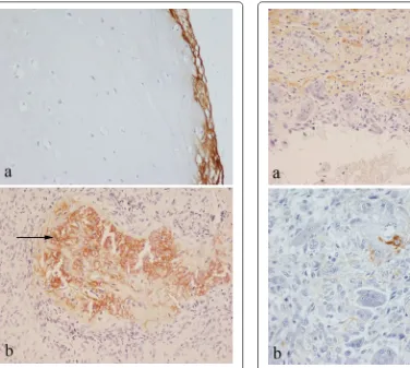 Fig. 2 Immunohistochemical staining for periostin in: a benign osteochondroma showing staining of the perichondrium covering the (unstained) cartilage; b chondroblastoma showing staining in areas containing mineralised chondroid (arrowed)