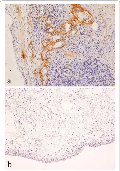 Fig. 4 Immunohistochemical staining for periostin in: a osteosarcoma showing staining of vessels and matrix in fatty marrow in non-neoplastic bone at the tumour margin (arrowed); b metastatic melanoma showing prominent staining of vessels within the tumour