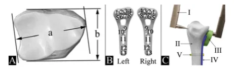 Fig. 1 Outline of the morphometric and distal screw lengthBcaliper (measurements. A) Maximum width (a) and maximum depth (b);) Screw numeration for right and left plate; C) Adapted digitalI), distal radius (II), distal drill guide block (III), volar plate(IV), screw to fix plate to bone (V)