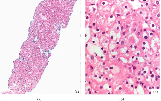 Figure 1: Contrast enhanced CT shows in the arterial phase a hypervascular small lesion in both kidneys, representing two smallchromophobe renal cell carcinomas