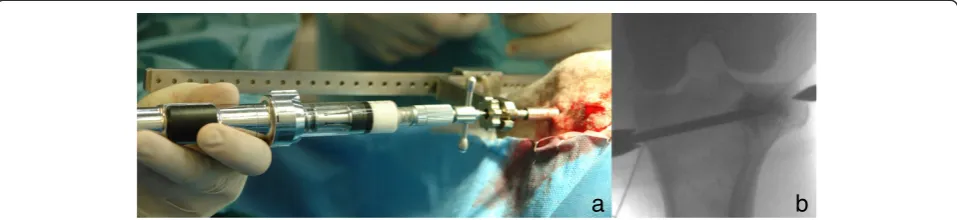 Figure 3 Injection procedure.control Injections were performed with an Optimed CementoRE gun (a) and made in multiple steps under fluoroscopic (b).
