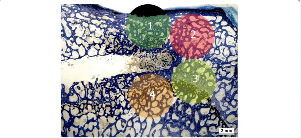Figure 5 Histomorphometrical evaluation. Histomorphometry was used to quantify the percentage of new bone, old bone, granulation tissue,and residual augmentation material within the area of interest