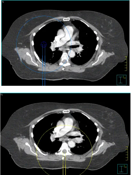 Figure 3. Isocenter locations for the spinal cord and lung SmartArc deliveries. 