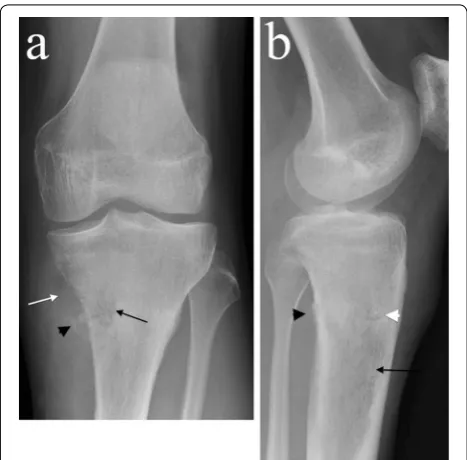 Fig. 1 a AP and lateral b plain radiographs demonstrate an ill-defined radiolucent lesion in the proximal tibial metadiaphysis (black arrows) with posteromedial cortical destruction and adjacent ossifica-tion (black arrowheads)