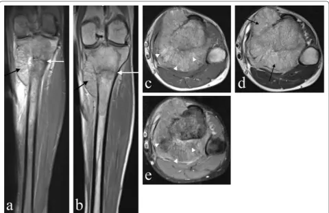 Fig. 2 Magnetic Resonance Imaging (MRI) of the proximal tibial lesion. a Coronal STIR, b coronal T1-, c axial T1-, d axial T2-weighted and, e axial pro-ton density with fat saturation