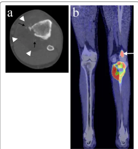 Fig. 3 Axial CT and PET/CT imaging of the proximal tibial lesion. a Axial CT imaging shows medial cortical destruction and a large soft tissue mass containing areas of fat attenuation (white arrowheads) and ossification (black arrows)